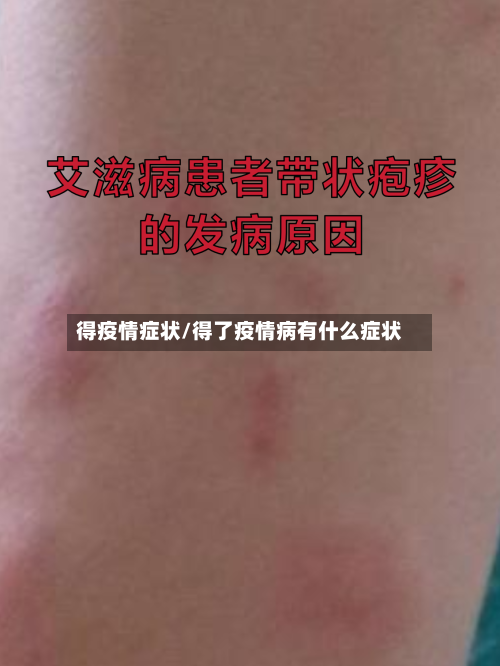 得疫情症状/得了疫情病有什么症状-第2张图片