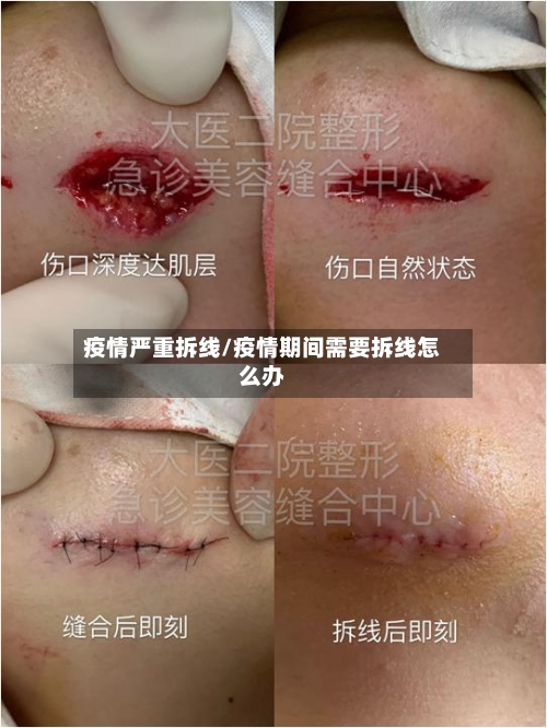 疫情严重拆线/疫情期间需要拆线怎么办-第3张图片